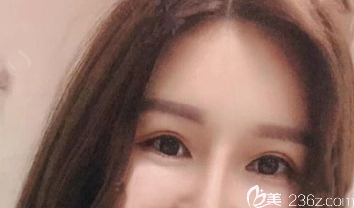 全切双眼皮失败修复第54天恢复情况 全切双眼皮失败修复第54天恢复情况