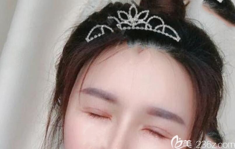 孙洋做眼部修复手术第8天闭眼照片 孙洋做眼部修复手术第8天闭眼照片