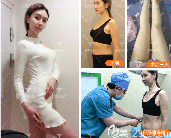 北京润美玉之光王明利腿部和腹部吸脂案例