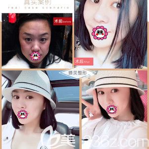 哈尔滨臻美双眼皮案例 哈尔滨臻美双眼皮案例