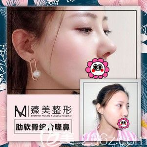 哈尔滨臻美肋软骨隆鼻对比效果 哈尔滨臻美肋软骨隆鼻对比效果