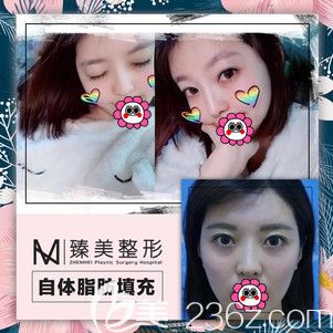 哈尔滨臻美自体脂肪填充面部效果图 哈尔滨臻美自体脂肪填充面部效果图