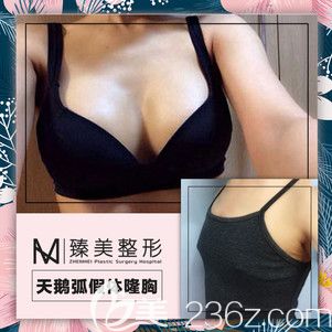 哈尔滨臻美天鹅弧隆胸对比效果 哈尔滨臻美天鹅弧隆胸对比效果