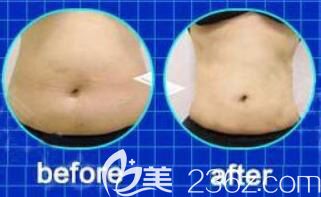 哈尔滨臻美吸脂瘦腰腹效果对比图 哈尔滨臻美吸脂瘦腰腹效果对比图