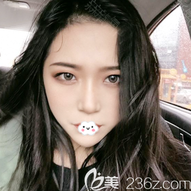 深圳美莱做鼻翼缩小手术效果怎么样