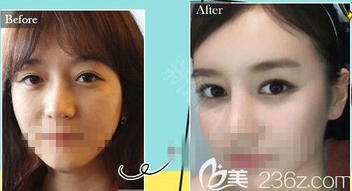 医院真人案例对比图片