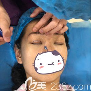 苏州康美医生划线设计眼综合