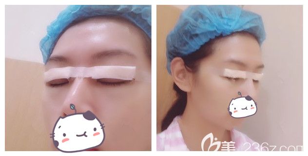 刚做完切开重睑+上睑下垂矫正