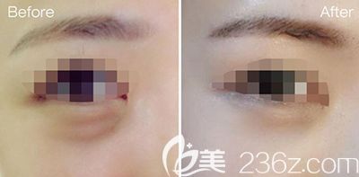 韩国bonps整形外科眼部整形照片