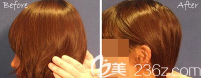 韩国bonps整形外科后脑勺填充照片