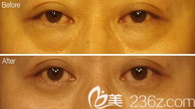 韩国bonps整形外科眼底整形照片