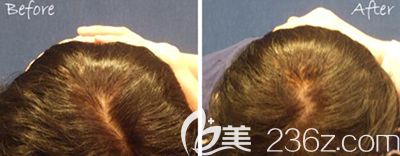 韩国bonps整形外科骨水泥填充后脑勺图片