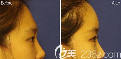 韩国bonps整形外科额头填充照片