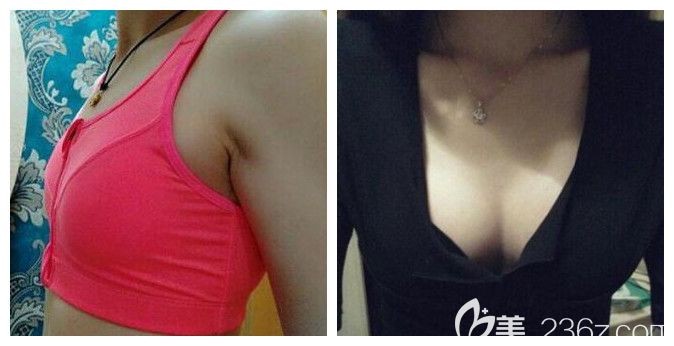 聊城韩美整形自体脂肪隆胸案例