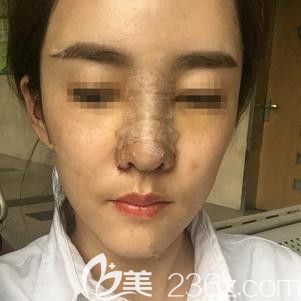 李春雷医生为我刚做完隆鼻失败修复术后鼻子微肿