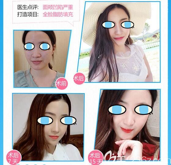 聊城韩美整形全脸自体脂肪填充案例