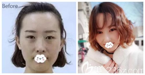 唐山苏亚美联臣做双眼皮案例 唐山苏亚美联臣做双眼皮案例