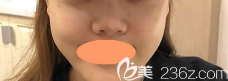 找景德镇圣嘉丽林丽德做了膨体+肋软骨隆鼻综合术前 找景德镇圣嘉丽林丽德做了膨体+肋软骨隆鼻综合术前