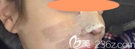 找景德镇圣嘉丽林丽德做了膨体+肋软骨隆鼻综合术即刻效果图 找景德镇圣嘉丽林丽德做了膨体+肋软骨隆鼻综合术即刻效果图