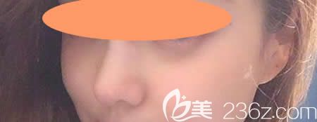 找景德镇圣嘉丽林丽德做了膨体+肋软骨隆鼻综合术第48天 找景德镇圣嘉丽林丽德做了膨体+肋软骨隆鼻综合术第48天