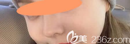 丑了25年的蒜头鼻，找景德镇圣嘉丽刘志强做了膨体+肋软骨隆鼻综合术竟如同换了一张脸