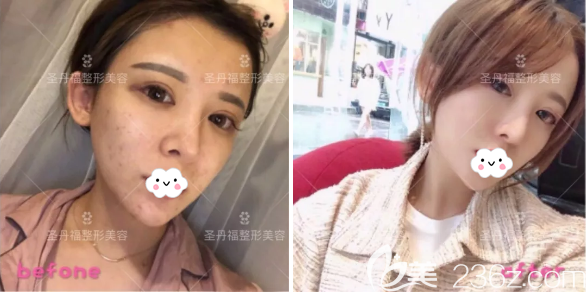 <i data-id='fcd48632-f725-42b7-842d-b8666f304a57' style='display:none;'></i>李沛明M22祛斑效果图