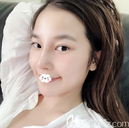 隆鼻失败修复术后9天拆线效果图