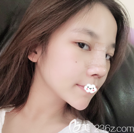 找深圳美莱梁志为做隆鼻修复第六天恢复效果