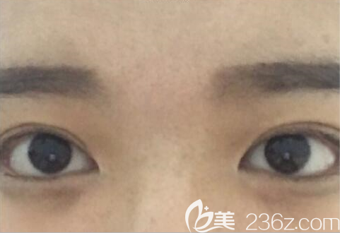 眼角修复韩国bio曹仁昌价格RMB2万多点总体满意没有疤痕