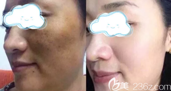 <i data-id='25870959-1e44-4006-95b1-1c0043e5e684' style='display:none;'></i>玉之光祛斑治疗效果展示