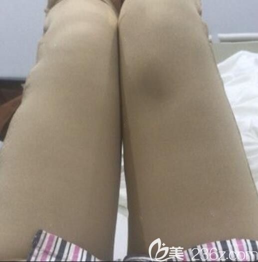 水动力吸脂瘦大腿术后当天
