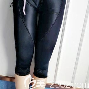 李东霖大腿抽脂术后第8天变化图