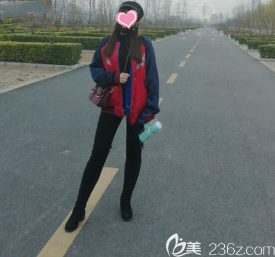 水动力大腿吸脂34天效果图