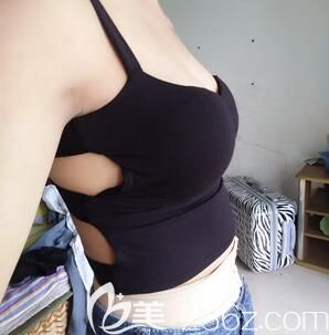 我在南宁华美整形做完吸脂丰胸第7天