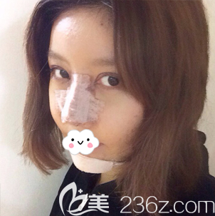 韩国普罗菲耳（profile）整形医院隆鼻丰下巴术后即刻照片