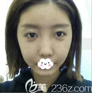 韩国普罗菲耳(profile)整形医院鼻综合术前照 韩国普罗菲耳(profile)整形医院鼻综合术前照