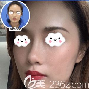 孝感天妃玻尿酸注射术后对比效果