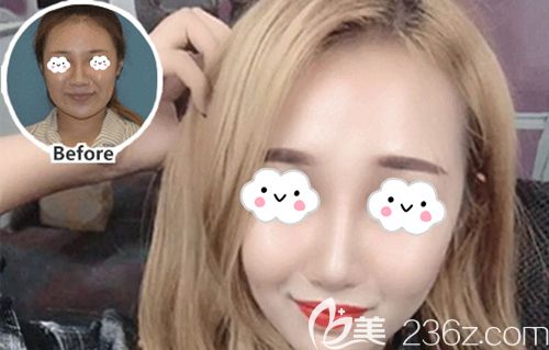 柳肖医生做硅胶隆鼻术后45天鼻形自然