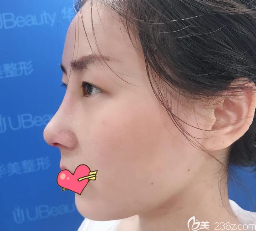 合肥华美整形鼻部失败修复术后第7天拆线后照片