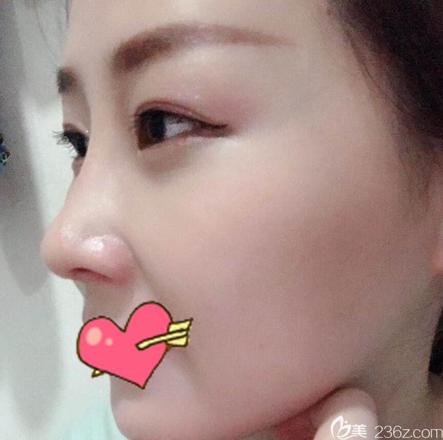华美整形隆鼻失败修复术后16天恢复情况