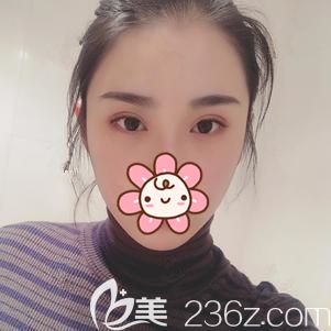 做切开双眼皮术后7天到院拆线肿胀消除 做切开双眼皮术后7天到院拆线肿胀消除