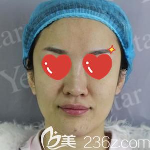 到武汉艺星做自体脂肪面部填充术前面颊凹陷的自己 到武汉艺星做自体脂肪面部填充术前面颊凹陷的自己