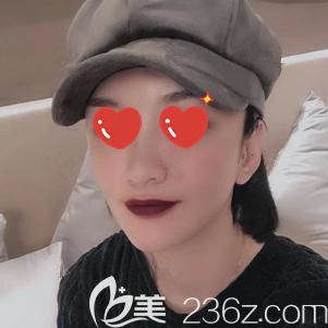 做自体脂肪面部填充术后15天肿胀消除面部饱满 做自体脂肪面部填充术后15天肿胀消除面部饱满