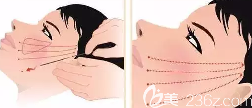 面部埋线提升示例图