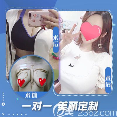 石家庄蓝山做隆胸手术案例