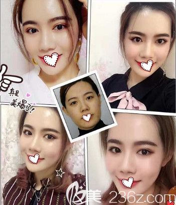 蓝山整形做脂肪填充面部案例