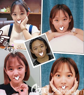 石家庄蓝山做双眼皮案例