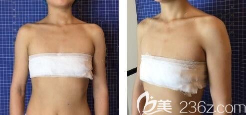 隆胸前,胸部平坦没有起伏 隆胸前,胸部平坦没有起伏