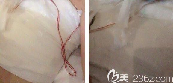 找合肥艺星孙洋做假体隆胸术后当天 找合肥艺星孙洋做假体隆胸术后当天