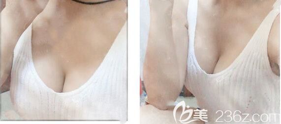 孙洋做曼托假体隆胸第28天变化图 孙洋做曼托假体隆胸第28天变化图